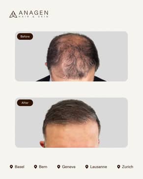 Slider image (8) Anagen - Hair Transplant Clinic in Switzerland